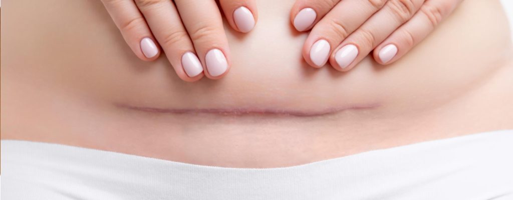 Scar Remodeling therapy Nicosia Cyprus