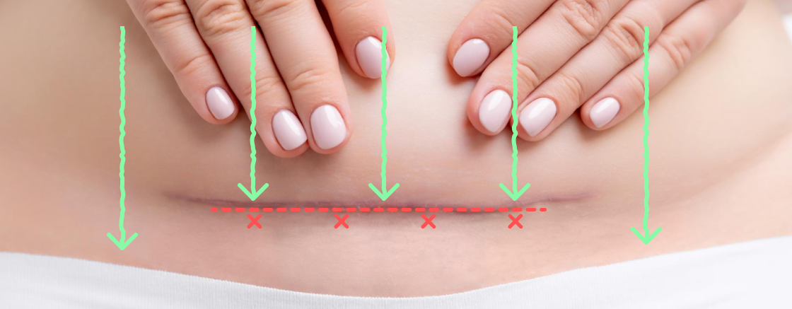 lymphatic issues after c-section scar remodeling